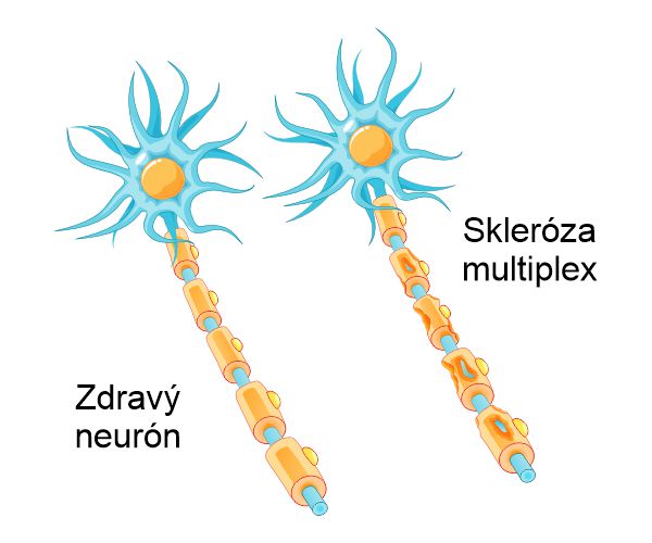 Zdravy neurón vs. Skleróza multiplex